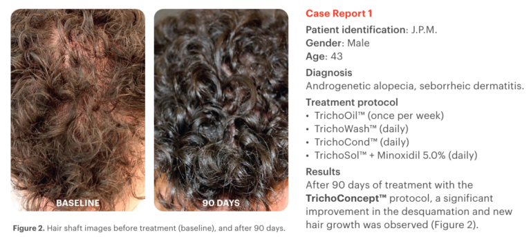 Etude de cas 2 sur un protocole TrichoConcept montrant l'efficacité des préparations magistrales sur l'alopécie