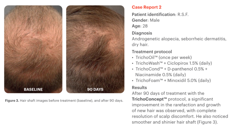 Etude de cas 1 sur un protocole TrichoConcept montrant l'efficacité des préparations magistrales sur l'alopécie